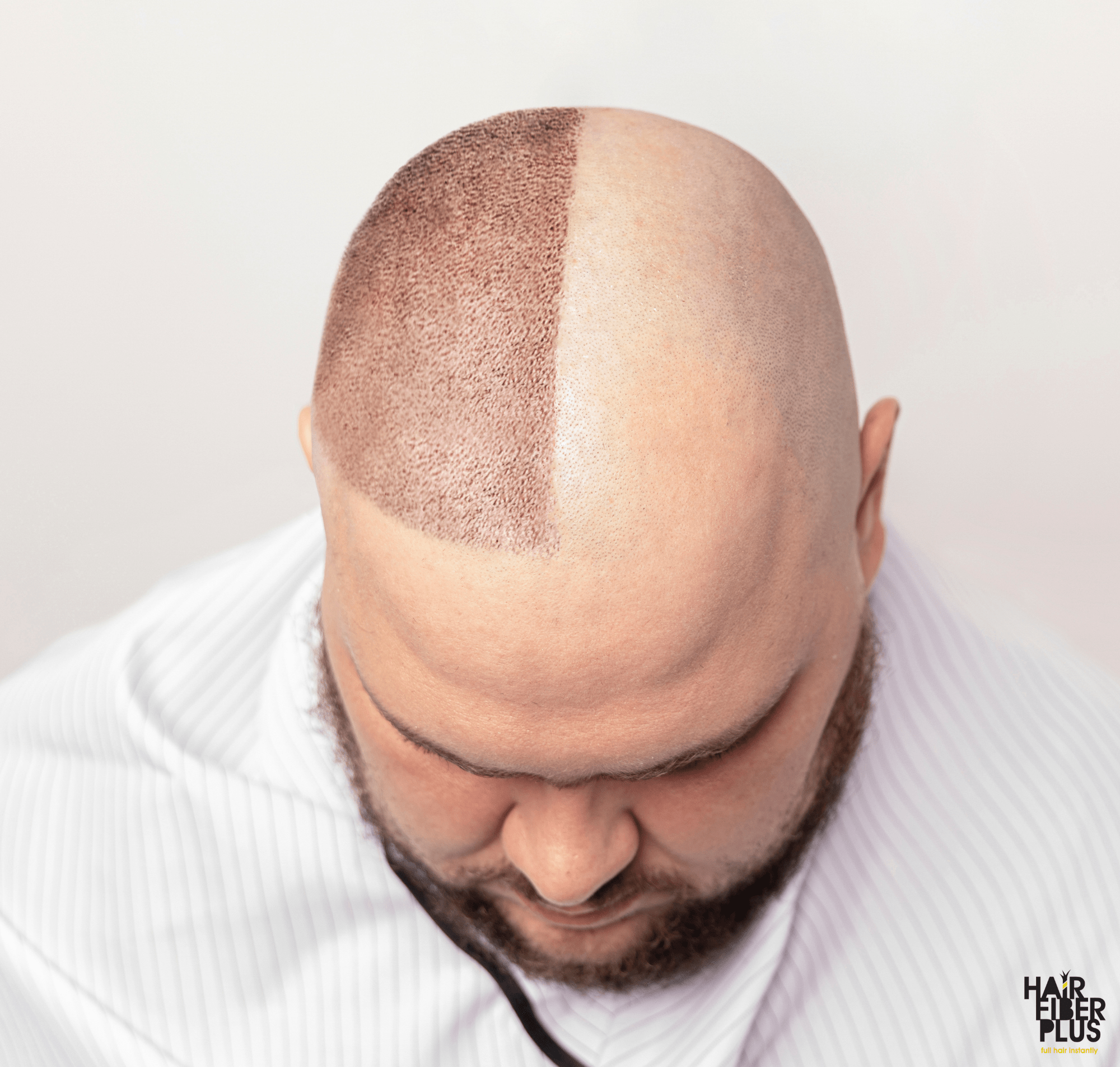 Trapianto di Capelli vs. Fibre di Cotone: Qual è la Migliore Soluzione?
