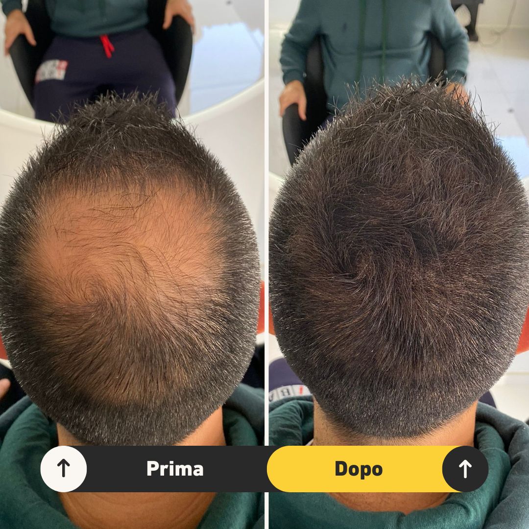 2 Fibre copri Calvizie da 27.5gr | Castano Scuro - HairFiberPlus