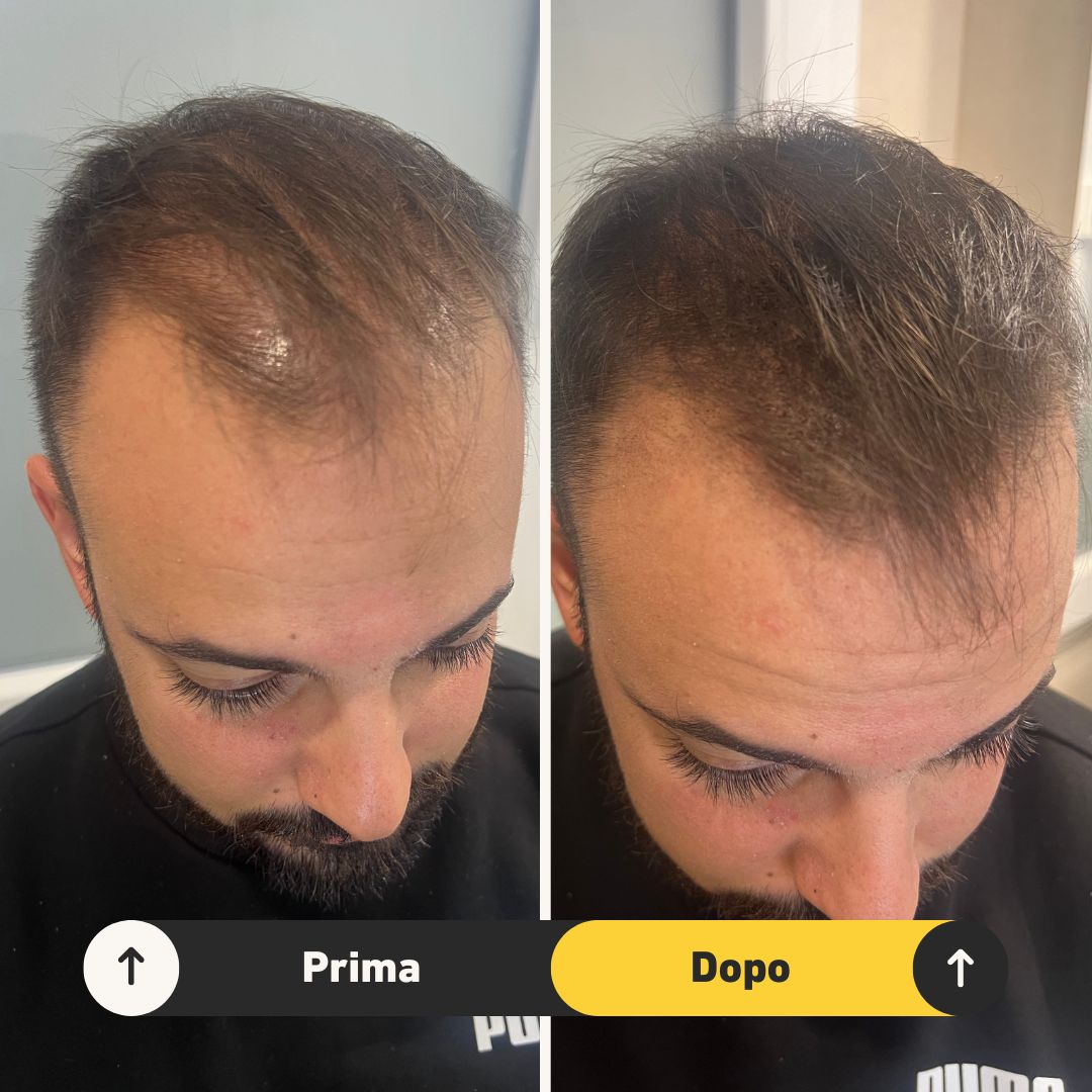 Fibre copri Calvizie da 7gr  | Castano Scuro | 15 Giorni Applicazione - HairFiberPlus