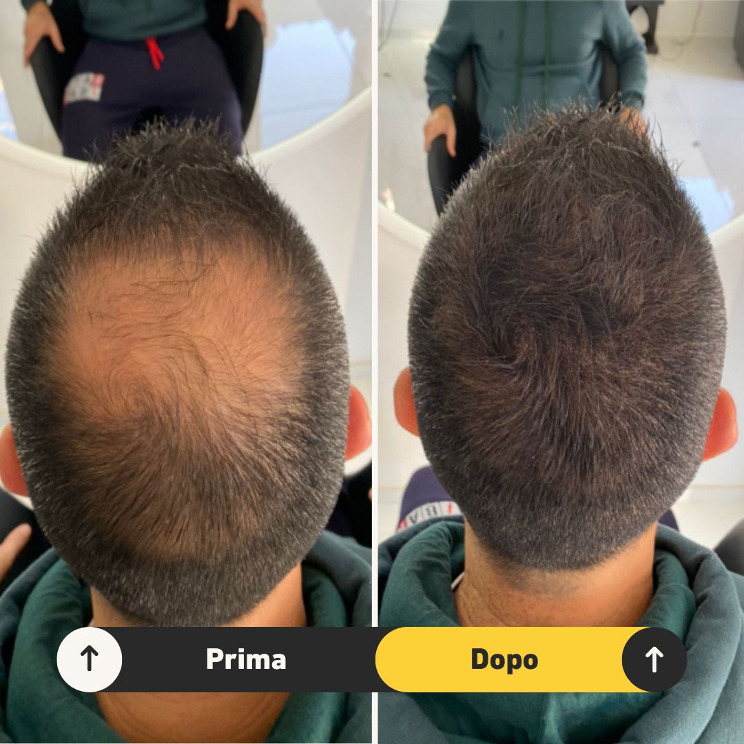 Fibre copri Calvizie da 7gr  | Castano Scuro | 15 Giorni Applicazione - HairFiberPlus