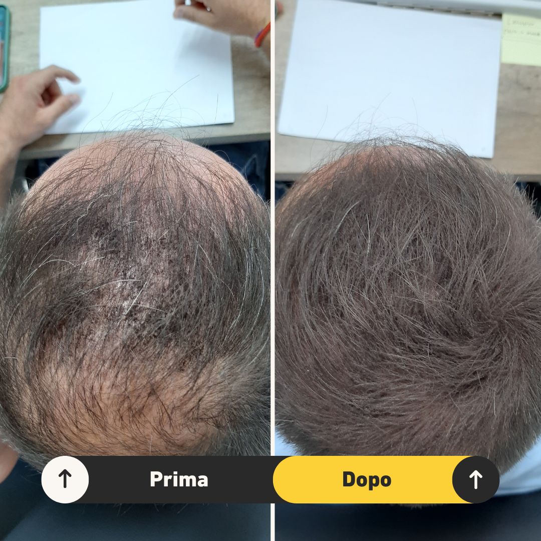 Fibre copri Calvizie da 7gr  | Castano Scuro | 15 Giorni Applicazione - HairFiberPlus