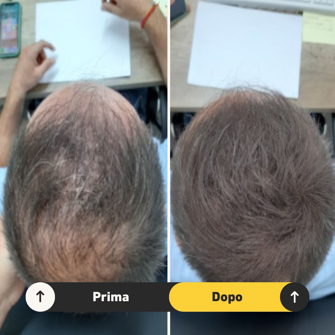 Fibre copri Calvizie da 7gr  | Castano Scuro | 15 Giorni Applicazione - HairFiberPlus