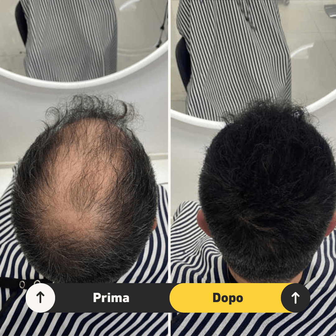 Fibre copri Calvizie da 7gr | Nero | 15 Giorni Applicazione - HairFiberPlus