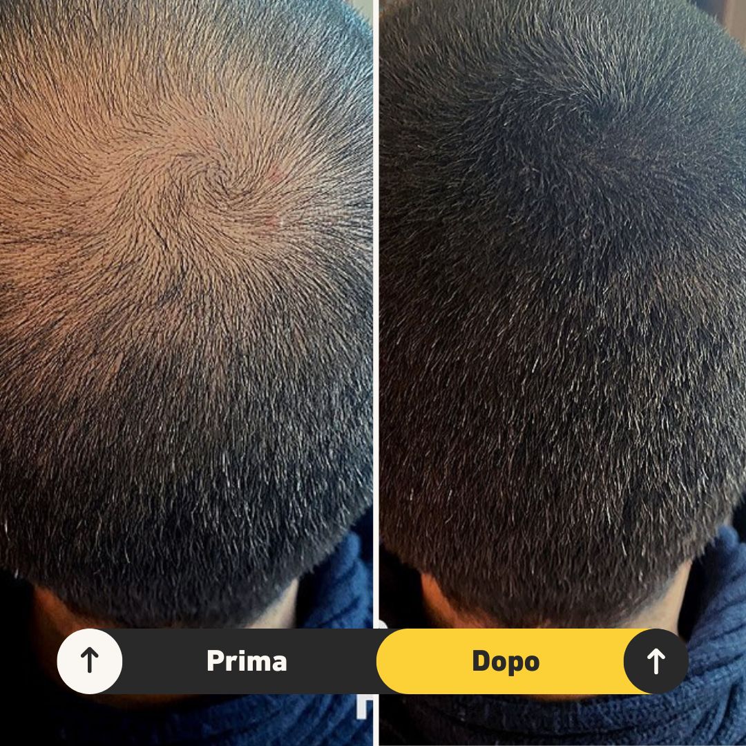 Fibre copri Calvizie da 7gr | Nero | 15 Giorni Applicazione - HairFiberPlus
