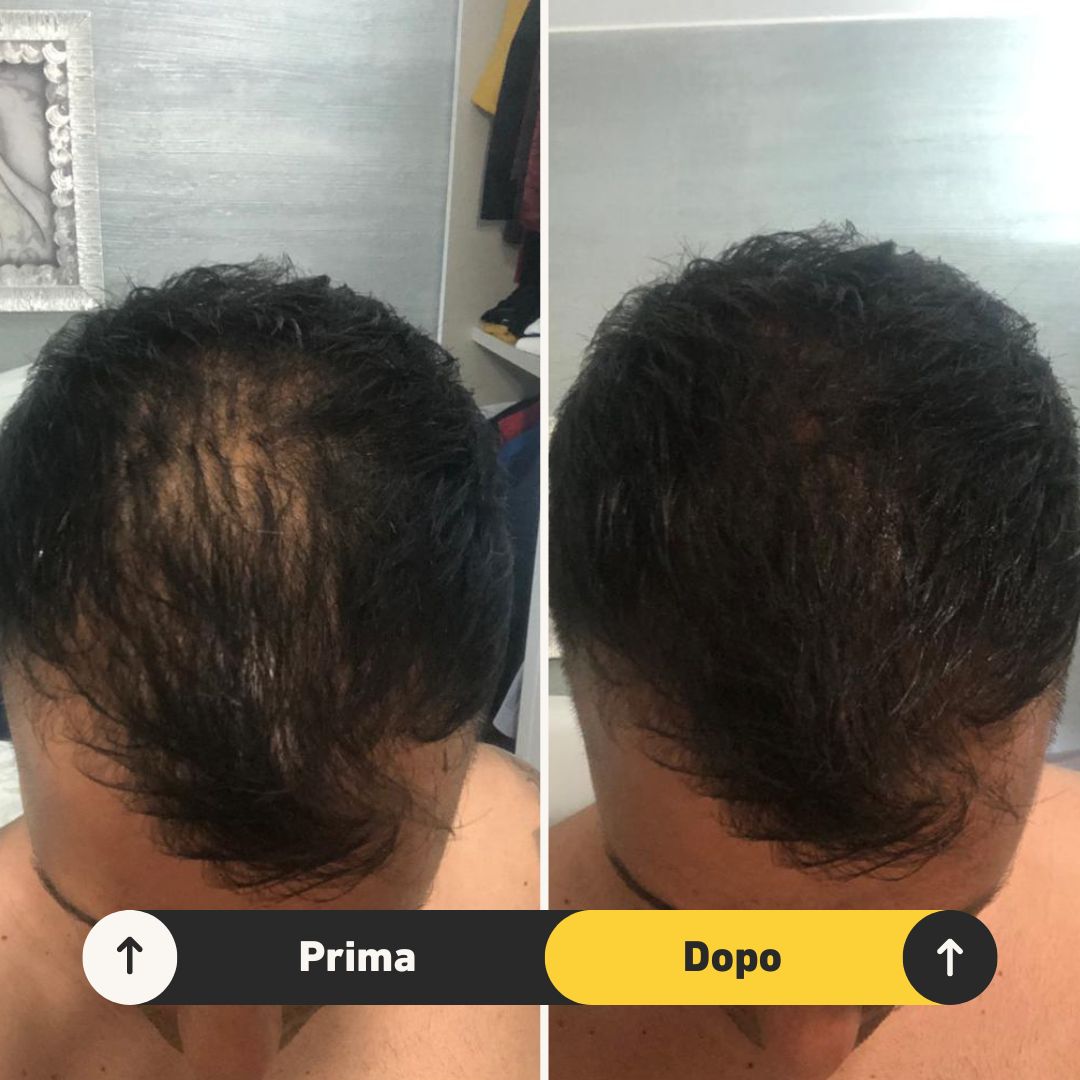 6 Fibre copri Calvizie da 27.5gr | Nero - HairFiberPlus