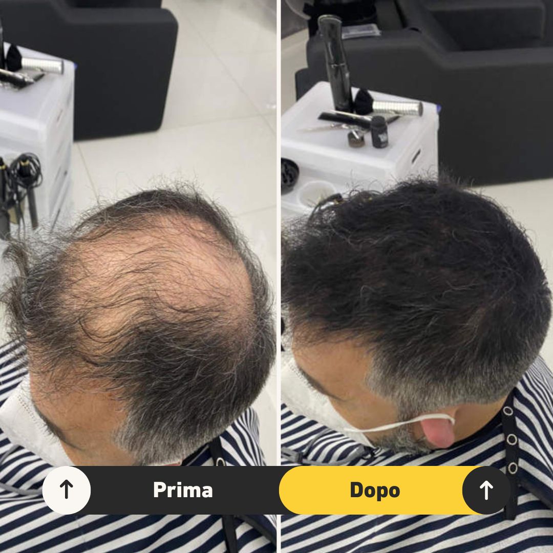 6 Fibre copri Calvizie da 27.5gr | Nero - HairFiberPlus