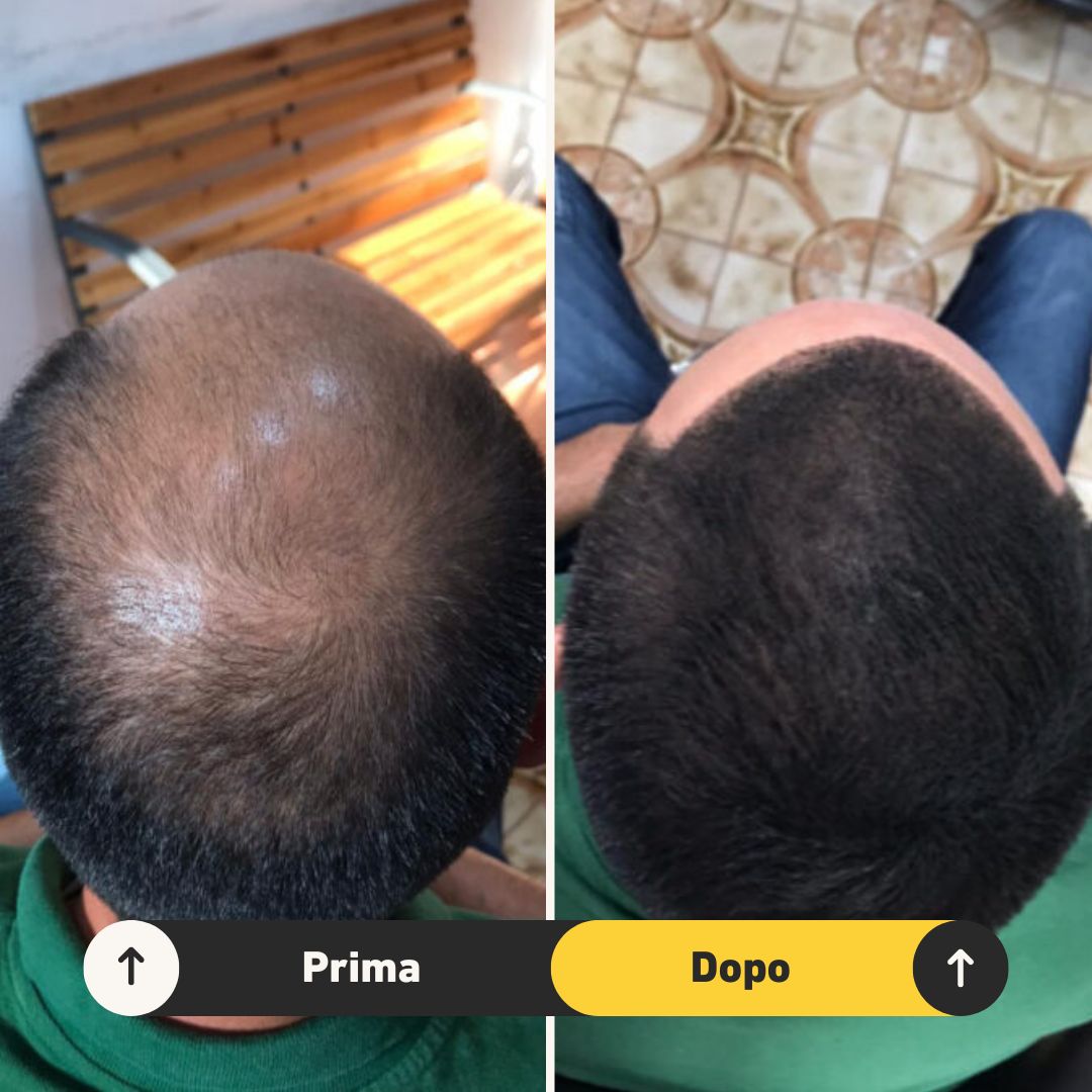 Fibre copri Calvizie da 7gr | Nero | 15 Giorni Applicazione - HairFiberPlus